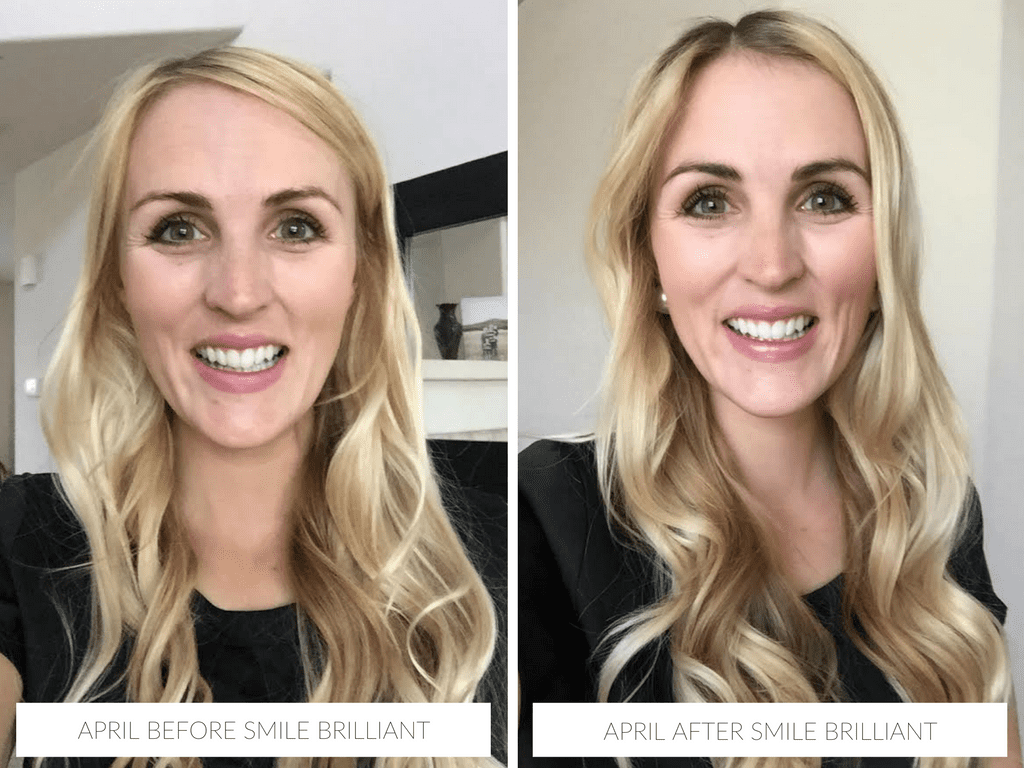 April before & after with Smile Brilliant teeth whitening @smilebrilliant #smilefearlessly