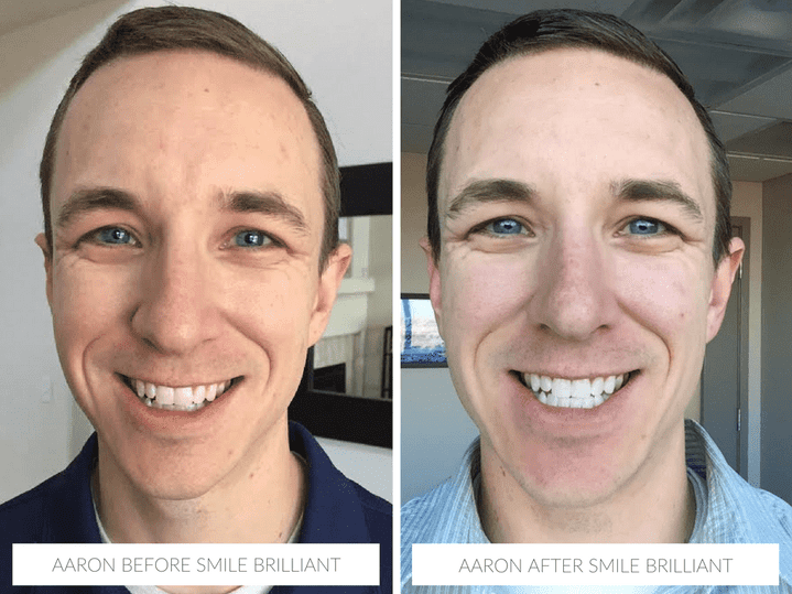 Aaron before & after with Smile Brilliant teeth whitening @smilebrilliant #smilefearlessly